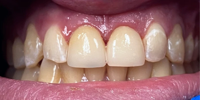 After - Dental transformation